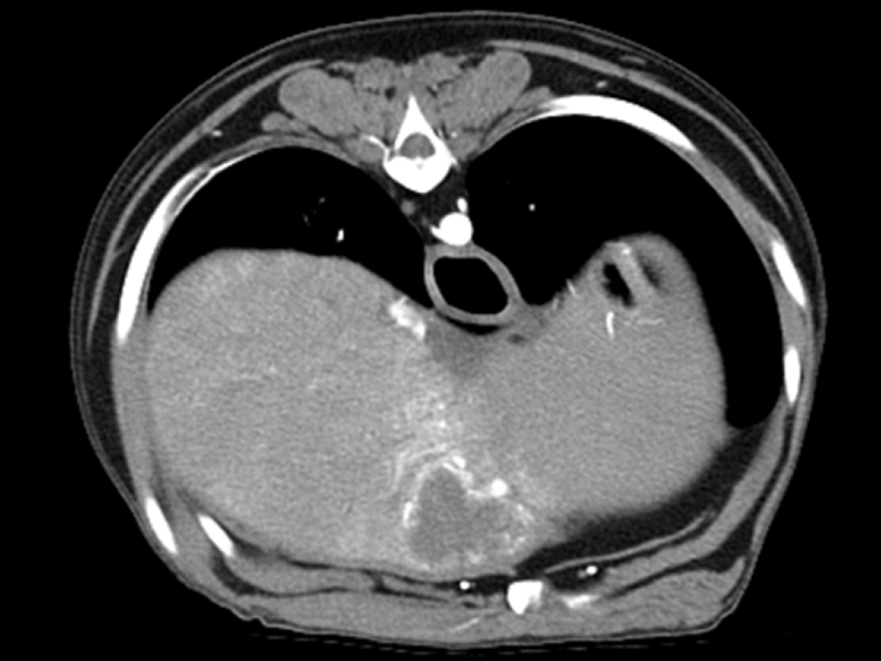 Early arterial phase